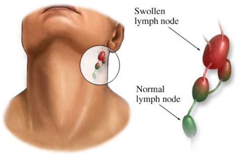 Lymph Node Differences, Swollen or Normal - CV ENT Surgical Group