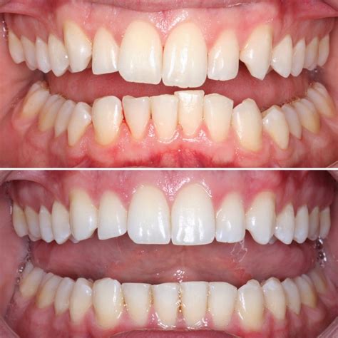 Invisalign Before and After | Schaumburg Dentistry