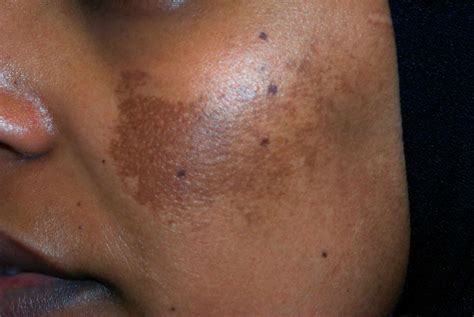 Treating Melasma In Pregnancy: The Self-Care Guide — Guardian Life — The Guardian Nigeria News ...