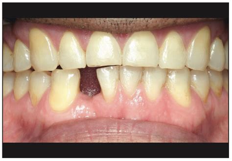 Ceramic Implants and Dental Implant Rehabilitation, Part I - Dentistry ...