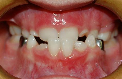 Cross Bite Before and After Braces Pictures | McCormick Orthodontics