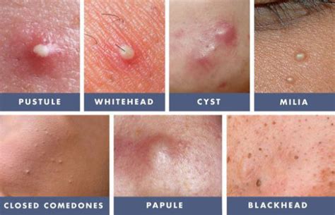 Acne Vulgaris Causes