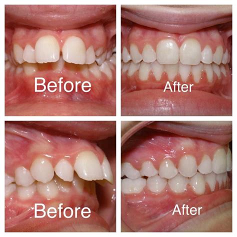 Orthodontist Braces Before And After