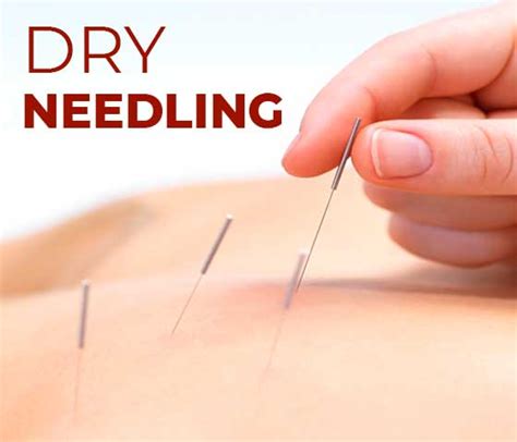 Dry Needling Treatment