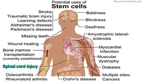 Neural Stem Cells Regenerate Axons in Severe Spinal Cord Injury ...