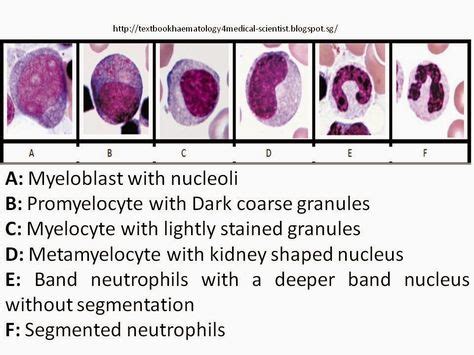 Immature Granulocytes in PBFs 1. Myeloblast Background Information of ...