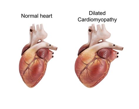 alcoholic cardiomyopathy life expectancy - Finest Blogging Pictures Library