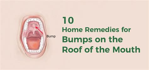 Bumps on the Roof of the Mouth: 10 Causes & Effective Home Remedies