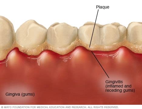 Best Of The Best Info About How To Get Rid Of Swollen Gums - Householdother