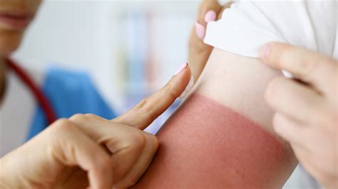 Sun poisoning: what it is and how to prevent it - Burn and Reconstructive Centers of America