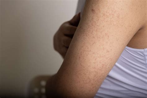 Topical Solutions for Keratosis Pilaris - Reviva Labs