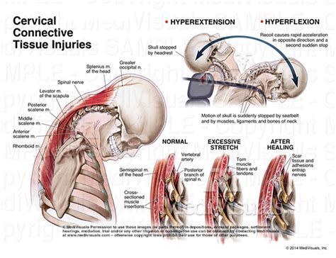 Cervical Connective Tissue Injury (a.k.a. “Whiplash,” “Cervical Soft ...