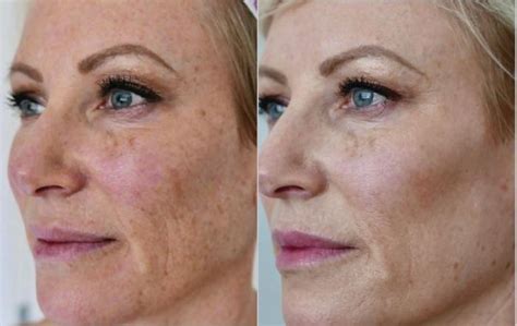 BBL® Laser Skin Rejuvenation Before and After Photo Gallery | Toronto ...