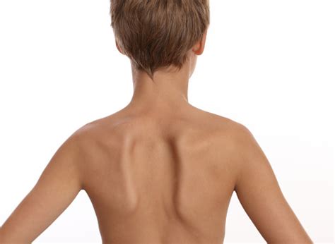 Kid With Uneven Shoulder Blades Scoliosis Exercises Treatments Stock ...