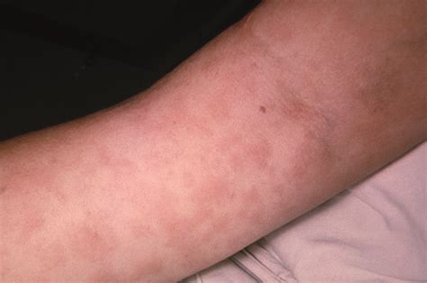 Penicillin allergy often inaccurately recorded by healthcare ...