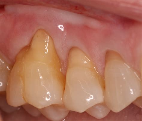 Gum Recession Treatment - Video - Ryan Lanman DDS, MSD