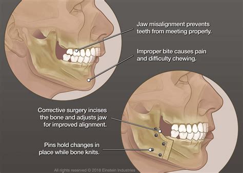 Corrective Jaw Surgery | Midwest Oral Surgery