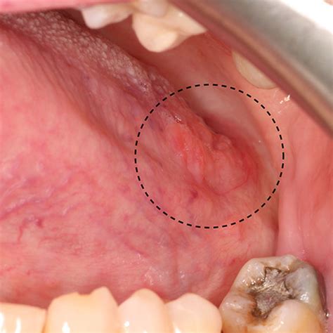 a GCF of the mandibular facial gingiva presenting as a pale pink... | Download Scientific Diagram