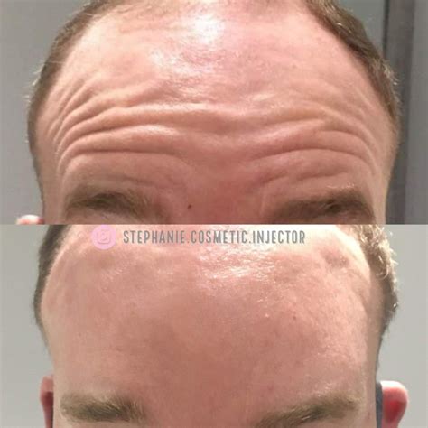 Forehead bottox, botox for men | Botox, Amazing transformations, Forehead