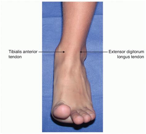 Arthroscopy of the Ankle | Musculoskeletal Key