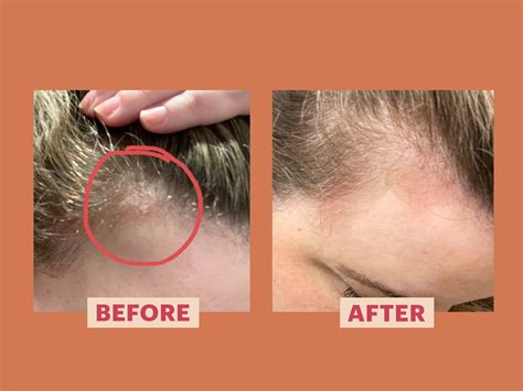 This DIY Treatment for Scalp Psoriasis Will Change Your Life Forever - My Shampoo