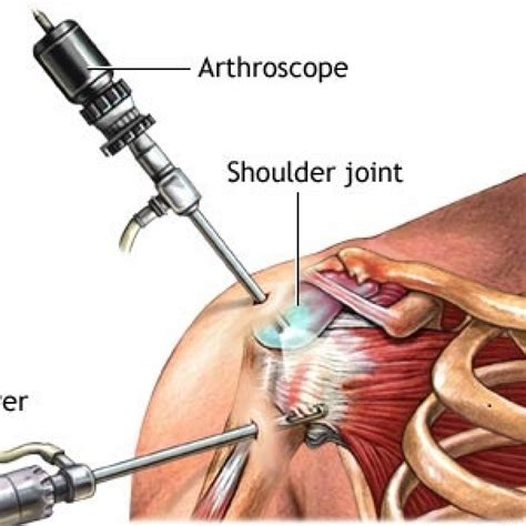 Rotator Cuff Repair Surgery Treatment India