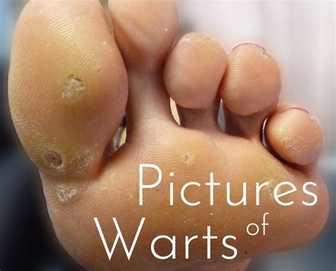 Pictures of Warts: Causes, Types and Home Treatments | HubPages