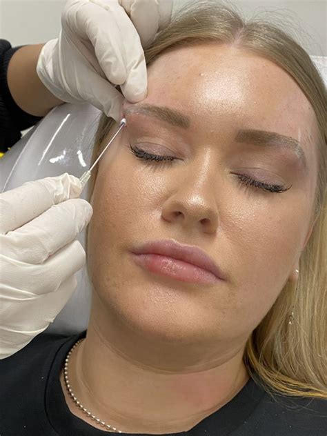 Fox Eye/ Brow Thread Lifts - Results Laser Clinic Eye Lifts From $180