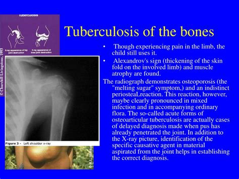 PPT - Osteomyelitis PowerPoint Presentation, free download - ID:969412