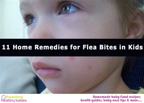 Flea Bites: 11 Effective Home Remedies for Kids