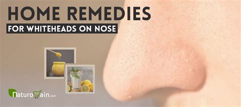 6 Home Remedies for Whiteheads on Nose, Chin and Cheeks