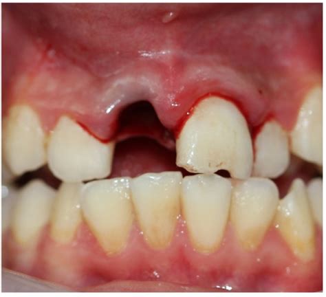 Dental avulsion - WikEM