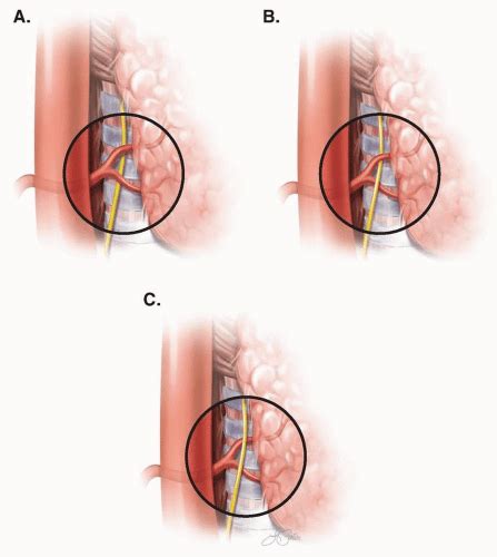 Thyroidectomy | Oncohema Key