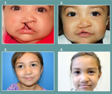 Cleft Lip And Palate Pdf