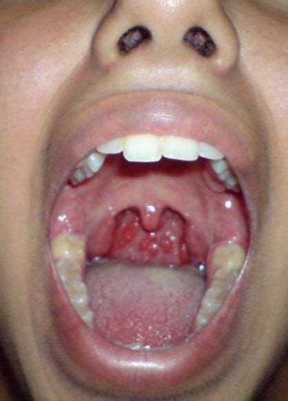 Lump In Back of Throat, Feeling, Hard, Large Lump, behind Uvula, near Tonsil, Right Side, Left ...