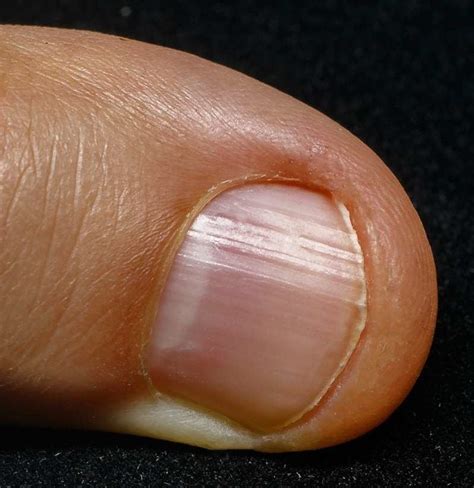 Anemia Toenails