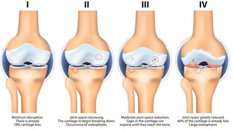 Osteoarthritis - Pathophysiology - Clinical Features - TeachMeSurgery