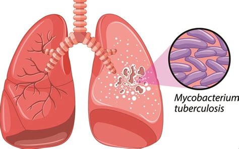 Bệnh lao phổi: Nguyên nhân, triệu chứng và cách điều trị - An Tâm