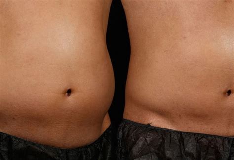 SculpSure Before and After Pictures | LaserTheFat.com