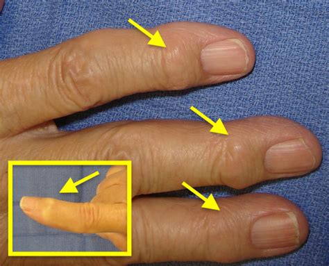 Osteoarthritis Nodules On Finger Joints