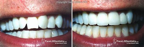 Crooked Teeth Before And After Braces - Dental News Network