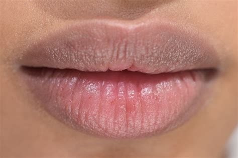 How To Treat Chapped Lips Overnight In Three Easy Steps — PHOTOS