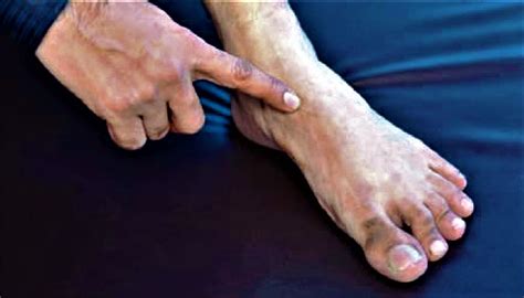 Navicular fracture causes, symptoms, diagnosis, treatment & prognosis