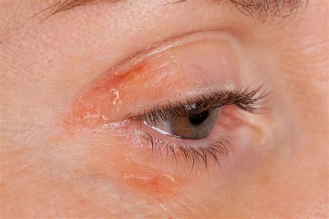 Psoriasis Eyes: Symptoms, Conditions, Treatment