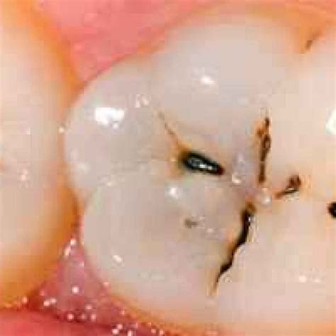 La cavitazione del dente: la carie dentaria (Cavitazione)
