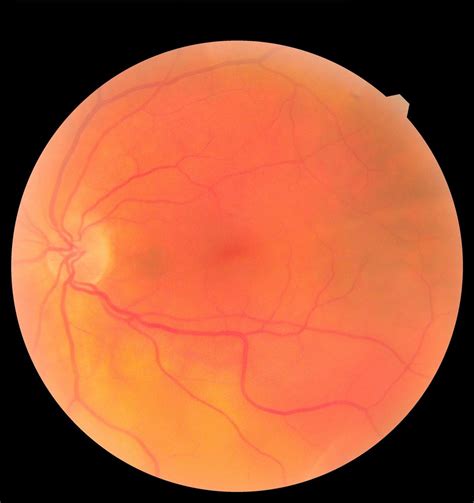 Diabetic Macular Edema : Overview, Causes, Symptoms, Treatment - illness.com