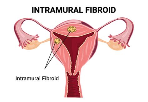 Intramural Fibroid - Vein & Endovascular Medical Care