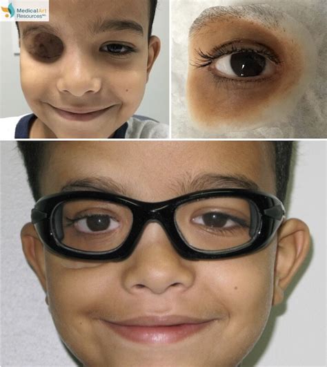 Orbital Prosthesis Photos - Prosthetic Eye and Eyelids — Life-like Prosthetics