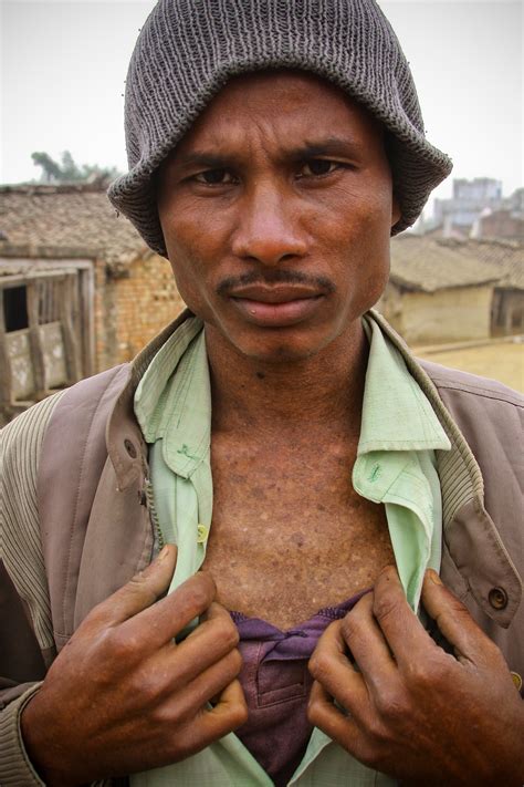 A 29-year-old man in Nawalparasi District in Nepal shows his blotched chest, a symptom of ...
