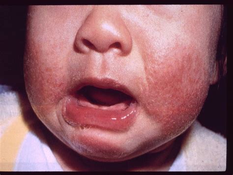 Baby eczema: causes, symptoms, treatment and more